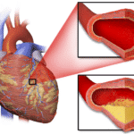 Coronary Artery Disease - TeachMeSurgery