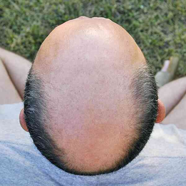 bald-truths:-the-excessive-price-of-quick-fix-hair-cures